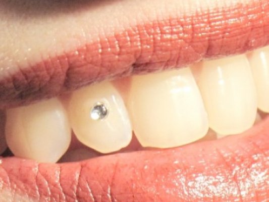 Bijuteriile dentare, la modă în Constanţa